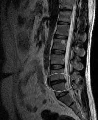 An MRI of a lumbar disc herniation between L4 and L5